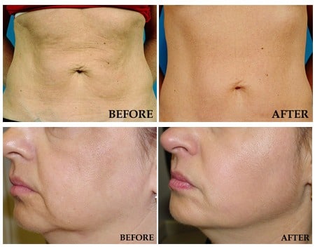 Thermage – The Procedure in NY