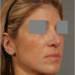 Rhinoplasty in Newburgh New York