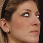 Rhinoplasty in NY