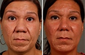 Nose Job in Goshen, Newburgh, Middletown, New York Nose Job in Goshen, Newburgh, Middletown, New York