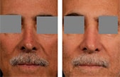 Nose Job in Goshen, Newburgh, Middletown, New York Nose Job in Goshen, Newburgh, Middletown, New York