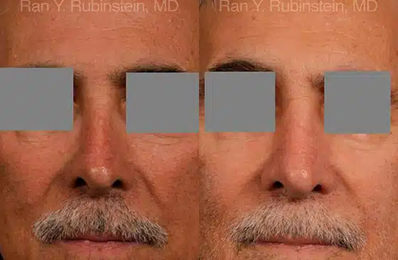 Non-Surgical Rhinoplasty by Dr. Ran Rubinstein's in Newburgh, NY.