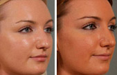 Liquid Rhinoplasty with Injectable Fillers > Newburgh > NY Liquid Rhinoplasty with Injectable Fillers > Newburgh > NY