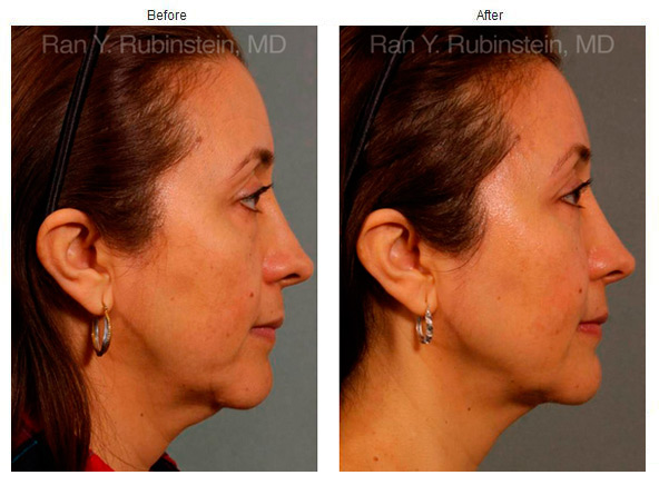 Facial smart lipo boring Your Facial smart lipo
