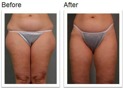 The Benefits of SmartLipo Triplex Over Traditional Liposuction