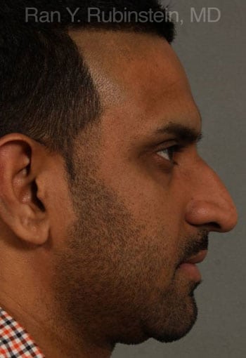 ethnic rhinoplasty - patient 3 - before 1 ethnic rhinoplasty - patient 3 - before 1