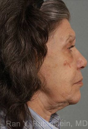laser treatment - patient 11 - before 2 laser treatment - patient 11 - before 2