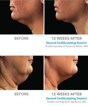 CoolSculpting Neck Before and After