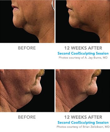 CoolSculpting Neck Before and After