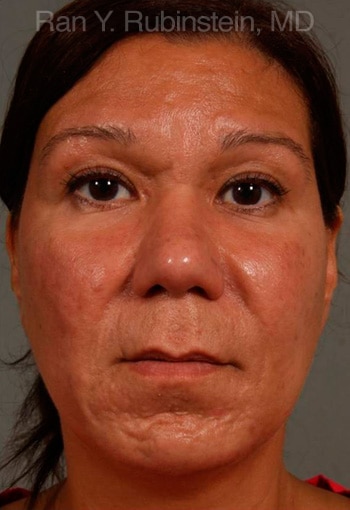 After Ethnic Rhinoplasty