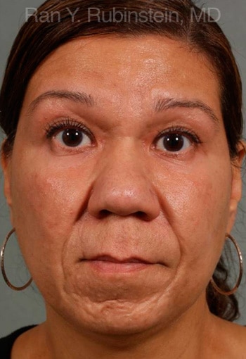 Before Ethnic Rhinoplasty