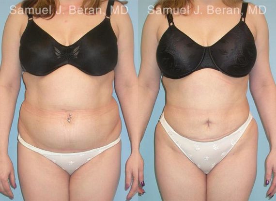 Abdominoplasty Before and After Photos in Newburgh, NY, Patient 12226