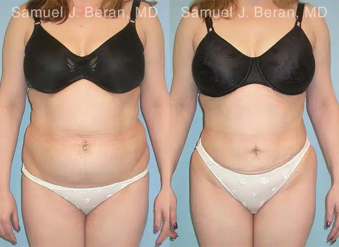 Abdominoplasty Before and After Photos in Newburgh, NY, Patient 12226