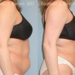 Abdominoplasty Before and After Photos in Newburgh, NY, Patient 12226