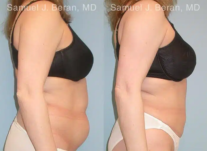 Abdominoplasty Before and After Photos in Newburgh, NY, Patient 12226