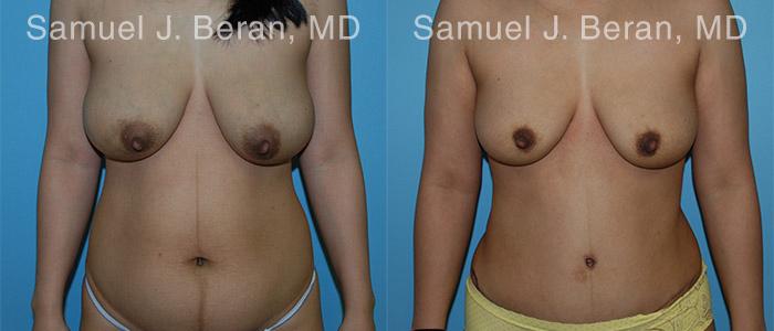 Abdominoplasty Before and After Photos in Newburgh, NY, Patient 12231