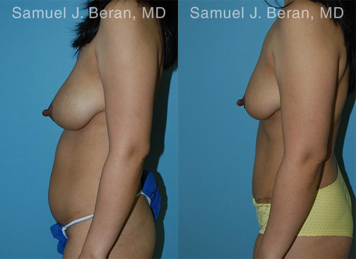 Abdominoplasty Before and After Photos in Newburgh, NY, Patient 12231