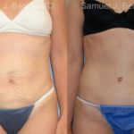 Abdominoplasty Before and After Photos in Newburgh, NY, Patient 12239