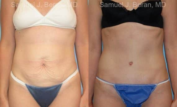 Abdominoplasty Before and After Photos in Newburgh, NY, Patient 12239