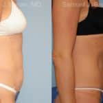 Abdominoplasty Before and After Photos in Newburgh, NY, Patient 12239