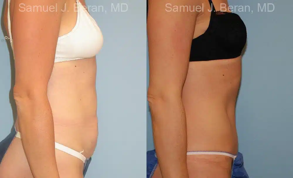 Abdominoplasty Before and After Photos in Newburgh, NY, Patient 12239