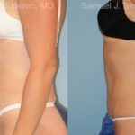 Abdominoplasty Before and After Photos in Newburgh, NY, Patient 12239