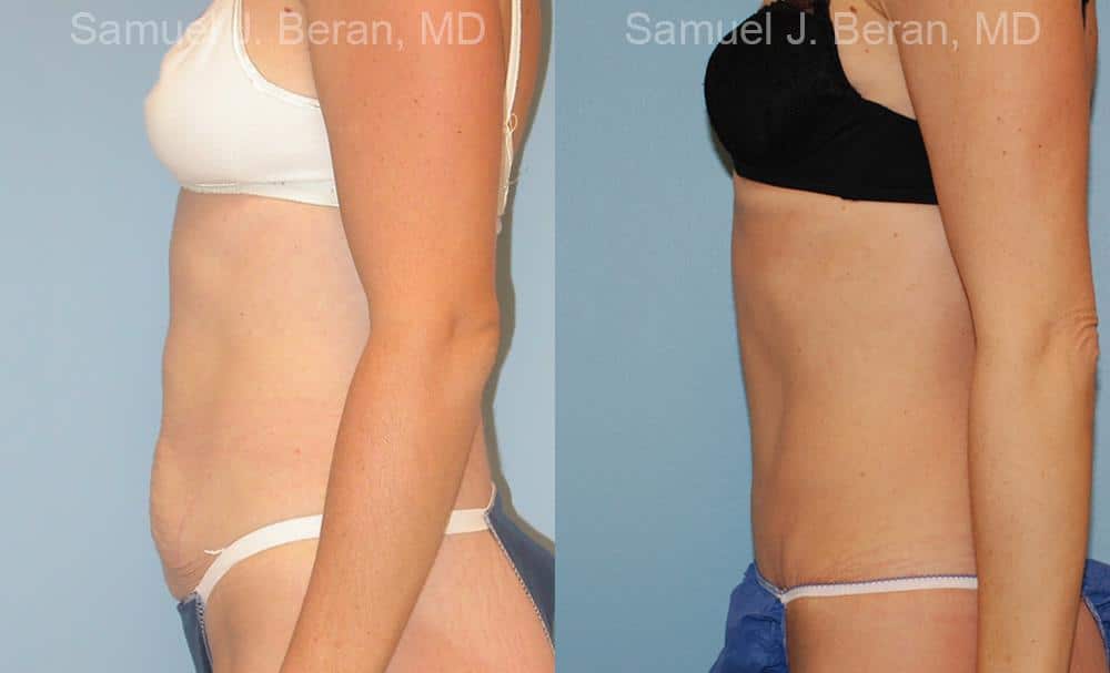 Abdominoplasty Before and After Photos in Newburgh, NY, Patient 12239