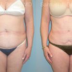 Abdominoplasty Before and After Photos in Newburgh, NY, Patient 12258