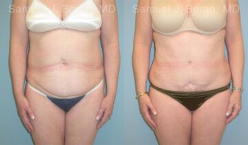 Abdominoplasty Before and After Photos in Montvale, NJ, Patient 12258