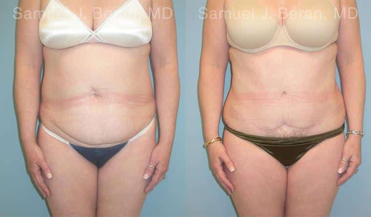 Abdominoplasty Before and After Photos in Newburgh, NY, Patient 12258