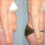 Abdominoplasty Before and After Photos in Newburgh, NY, Patient 12258