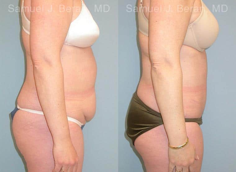 Abdominoplasty Before and After Photos in Newburgh, NY, Patient 12258