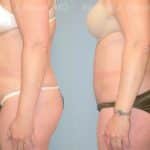 Abdominoplasty Before and After Photos in Newburgh, NY, Patient 12258