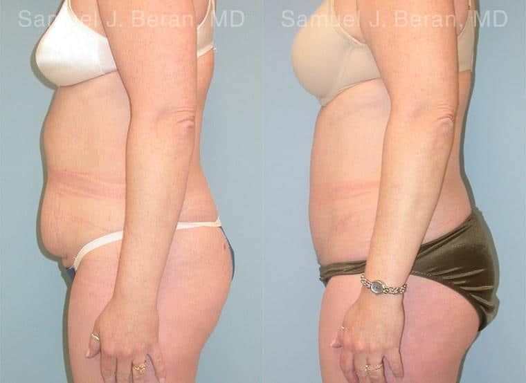 Abdominoplasty Before and After Photos in Newburgh, NY, Patient 12258