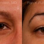 Botox Before and After Photos in Newburgh, NY, Patient 12268