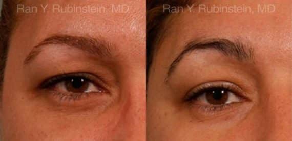 Botox Before and After Photos in Newburgh, NY, Patient 12268