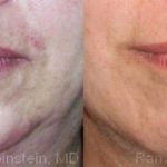 Botox Before and After Photos in Newburgh, NY, Patient 12291