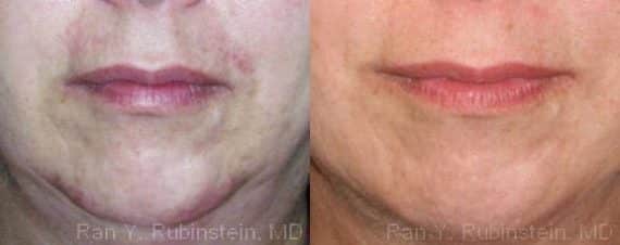 Botox Before and After Photos in Newburgh, NY, Patient 12291