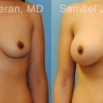 Breast Augmentation Before and After Photos in Newburgh, NY, Patient 12299