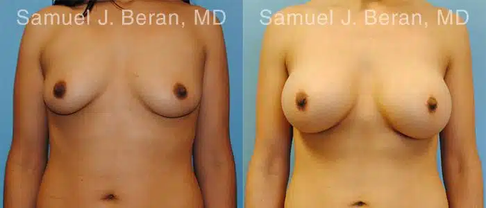 Breast Augmentation Before and After Photos in Newburgh, NY, Patient 12299