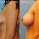 Breast Augmentation Before and After Photos in Newburgh, NY, Patient 12299