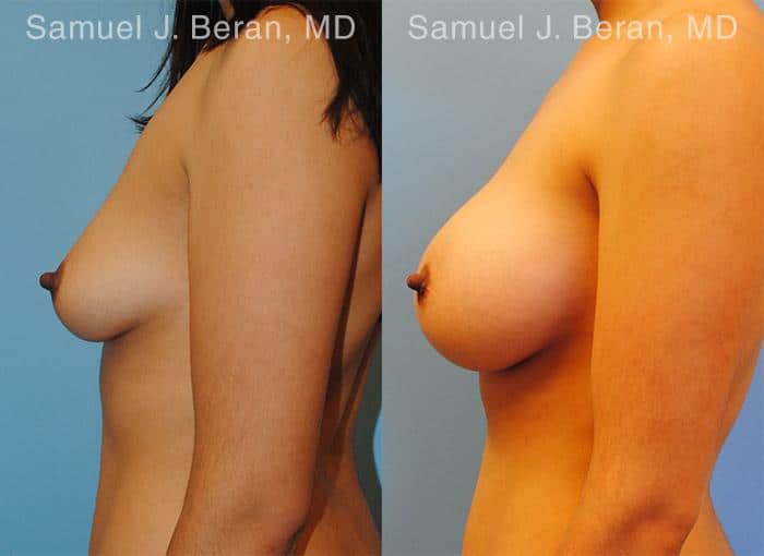 Breast Augmentation Before and After Photos in Newburgh, NY, Patient 12299