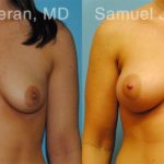 Breast Augmentation Before and After Photos in Newburgh, NY, Patient 12304