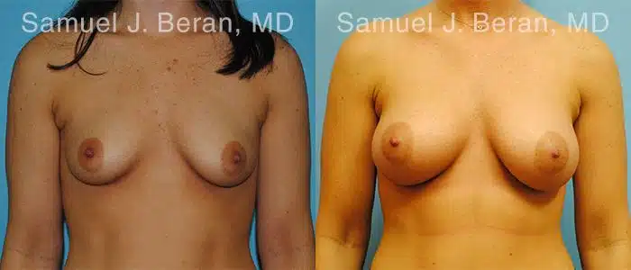 Breast Augmentation Before and After Photos in Newburgh, NY, Patient 12304