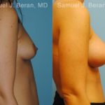 Breast Augmentation Before and After Photos in Newburgh, NY, Patient 12304