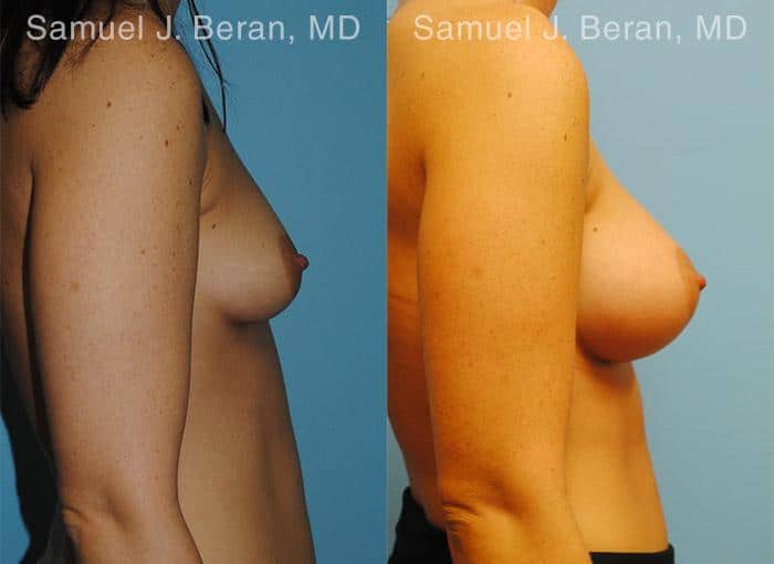 Breast Augmentation Before and After Photos in Newburgh, NY, Patient 12304