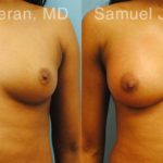 Breast Augmentation Before and After Photos in Newburgh, NY, Patient 12309