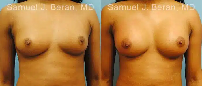 Breast Augmentation Before and After Photos in Newburgh, NY, Patient 12309