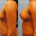 Breast Augmentation Before and After Photos in Newburgh, NY, Patient 12309