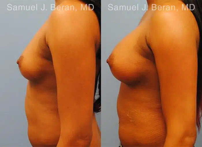 Breast Augmentation Before and After Photos in Newburgh, NY, Patient 12309